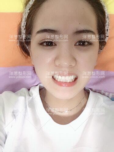 鄧悅醫(yī)生牙齒修復(fù)案例