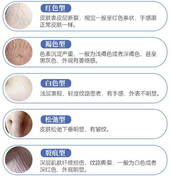 通過醫(yī)美的方式來去除肥胖紋