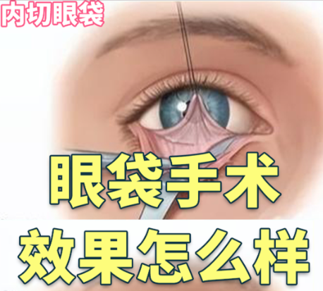 內(nèi)路去眼袋效果好嗎？2024實(shí)測真相：誰適合、能維持多久、避坑指南